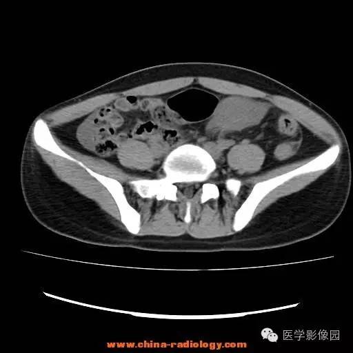 【病例】卵巢内胚窦瘤1例CT影像表现 【病例】卵巢内胚窦瘤1例CT影像表现