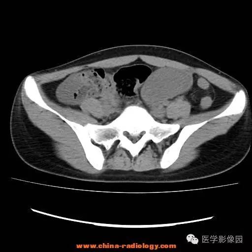 【病例】卵巢内胚窦瘤1例CT影像表现 【病例】卵巢内胚窦瘤1例CT影像表现