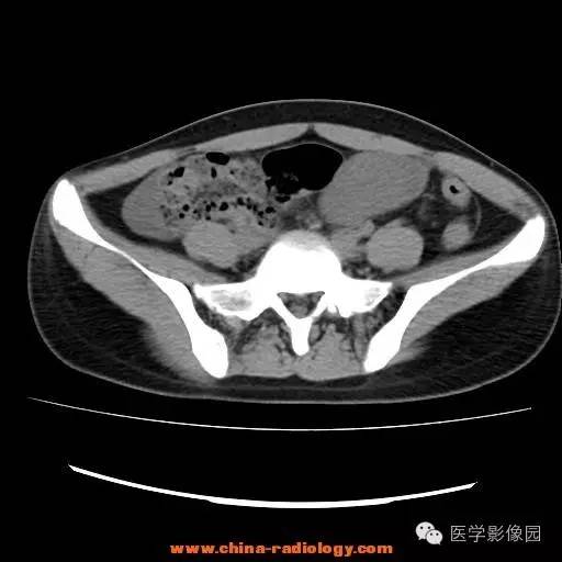 【病例】卵巢内胚窦瘤1例CT影像表现 【病例】卵巢内胚窦瘤1例CT影像表现