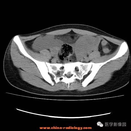 【病例】卵巢内胚窦瘤1例CT影像表现 【病例】卵巢内胚窦瘤1例CT影像表现