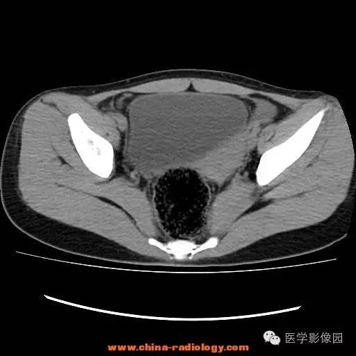 【病例】卵巢内胚窦瘤1例CT影像表现 【病例】卵巢内胚窦瘤1例CT影像表现