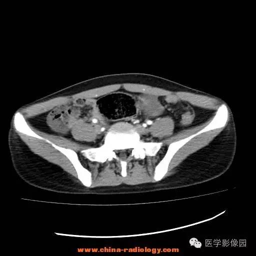 【病例】卵巢内胚窦瘤1例CT影像表现 【病例】卵巢内胚窦瘤1例CT影像表现