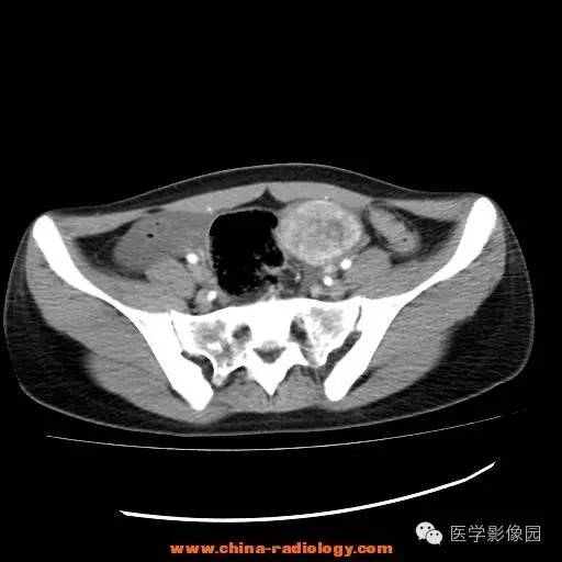 【病例】卵巢内胚窦瘤1例CT影像表现 【病例】卵巢内胚窦瘤1例CT影像表现