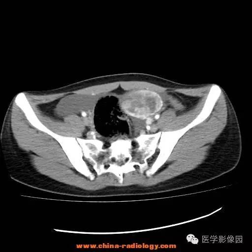 【病例】卵巢内胚窦瘤1例CT影像表现 【病例】卵巢内胚窦瘤1例CT影像表现