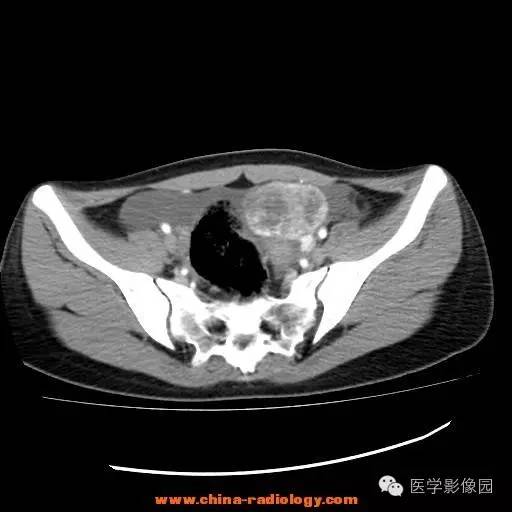 【病例】卵巢内胚窦瘤1例CT影像表现 【病例】卵巢内胚窦瘤1例CT影像表现