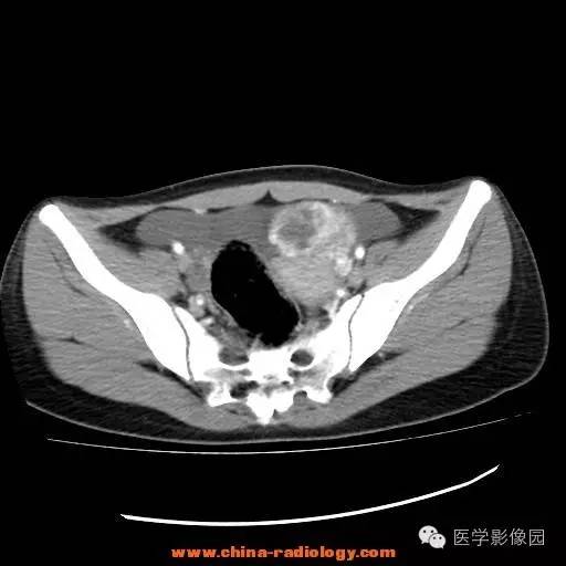 【病例】卵巢内胚窦瘤1例CT影像表现 【病例】卵巢内胚窦瘤1例CT影像表现