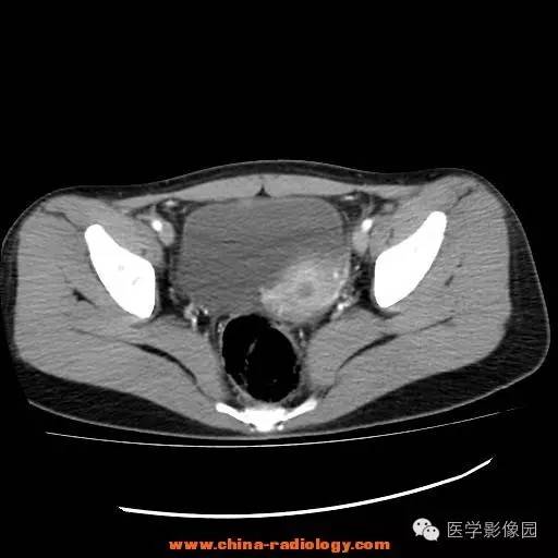【病例】卵巢内胚窦瘤1例CT影像表现 【病例】卵巢内胚窦瘤1例CT影像表现
