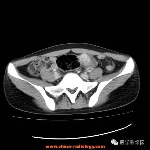 【病例】卵巢内胚窦瘤1例CT影像表现 【病例】卵巢内胚窦瘤1例CT影像表现