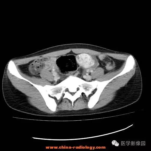 【病例】卵巢内胚窦瘤1例CT影像表现 【病例】卵巢内胚窦瘤1例CT影像表现