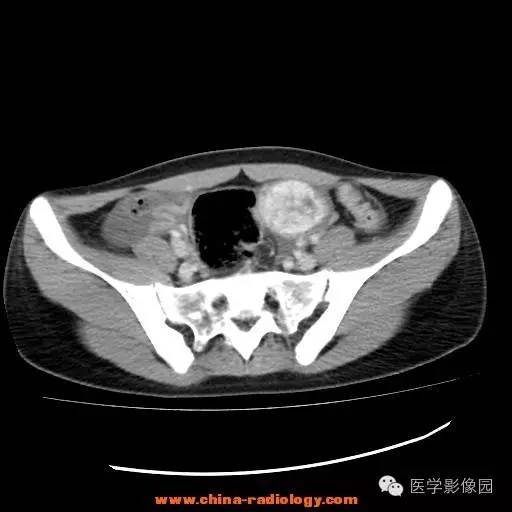 【病例】卵巢内胚窦瘤1例CT影像表现 【病例】卵巢内胚窦瘤1例CT影像表现