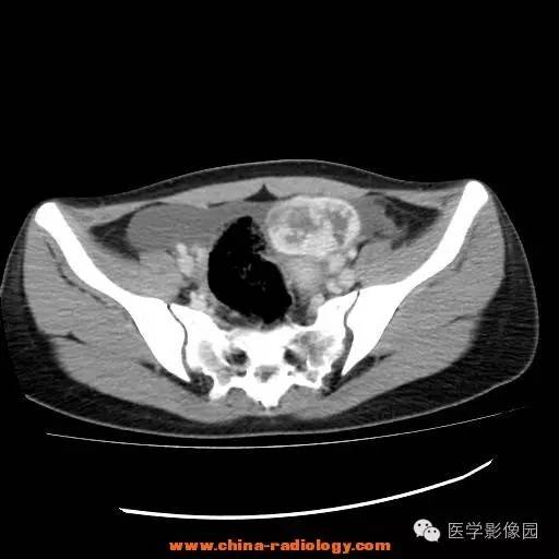 【病例】卵巢内胚窦瘤1例CT影像表现 【病例】卵巢内胚窦瘤1例CT影像表现