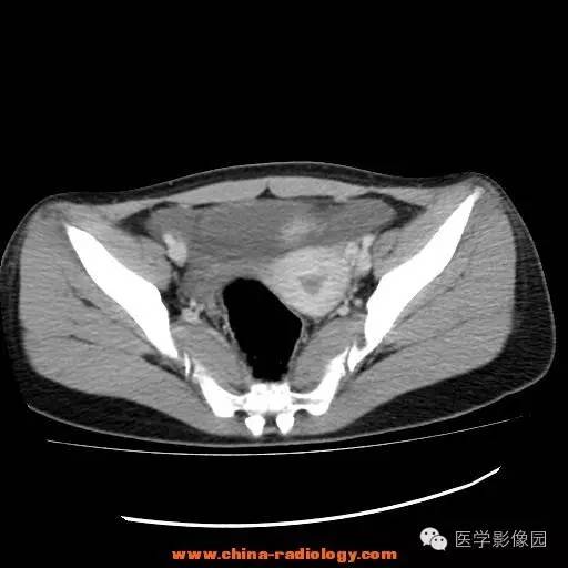 【病例】卵巢内胚窦瘤1例CT影像表现 【病例】卵巢内胚窦瘤1例CT影像表现