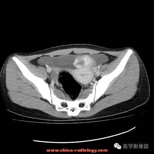 【病例】卵巢内胚窦瘤1例CT影像表现 【病例】卵巢内胚窦瘤1例CT影像表现