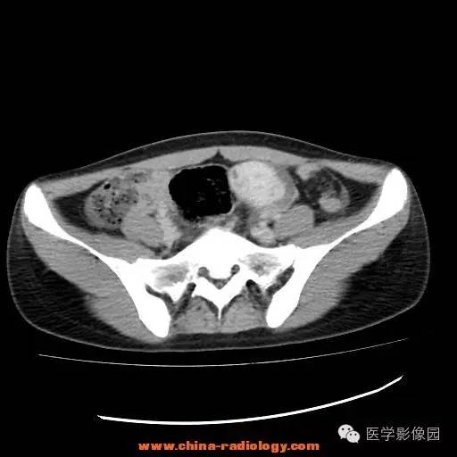 【病例】卵巢内胚窦瘤1例CT影像表现 【病例】卵巢内胚窦瘤1例CT影像表现