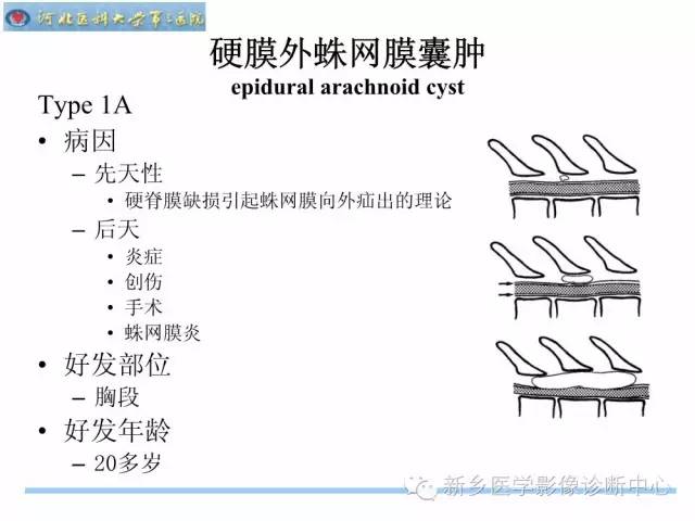 【PPT】椎管内囊性病变影像诊断