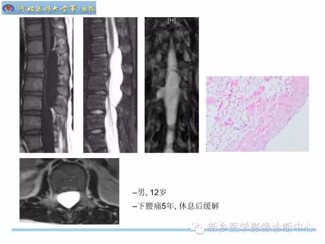 【PPT】椎管内囊性病变影像诊断