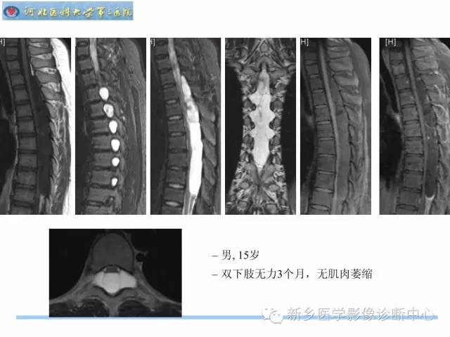 【PPT】椎管内囊性病变影像诊断