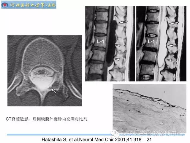 【PPT】椎管内囊性病变影像诊断