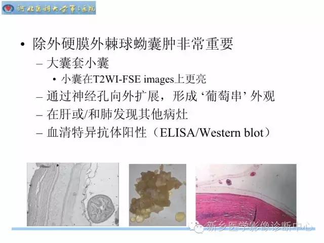 【PPT】椎管内囊性病变影像诊断
