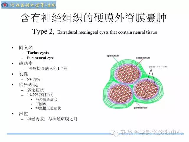 【PPT】椎管内囊性病变影像诊断
