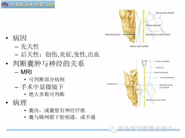 【PPT】椎管内囊性病变影像诊断