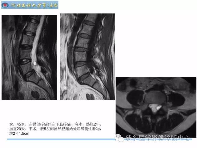 【PPT】椎管内囊性病变影像诊断