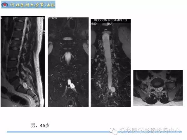【PPT】椎管内囊性病变影像诊断