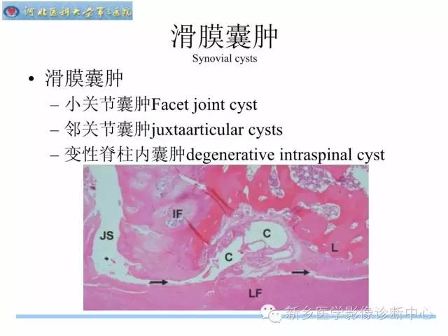 【PPT】椎管内囊性病变影像诊断