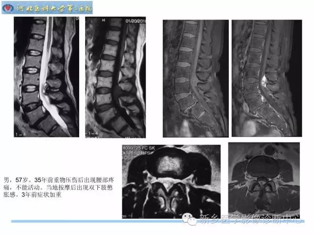 【PPT】椎管内囊性病变影像诊断