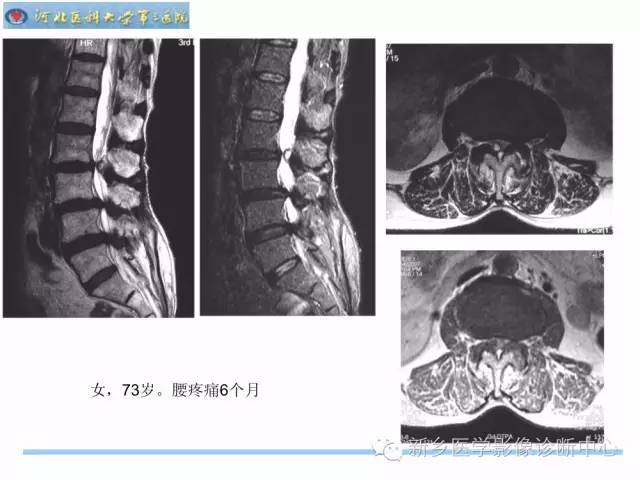 【PPT】椎管内囊性病变影像诊断