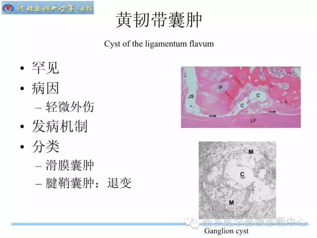 【PPT】椎管内囊性病变影像诊断