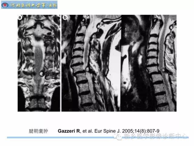 【PPT】椎管内囊性病变影像诊断