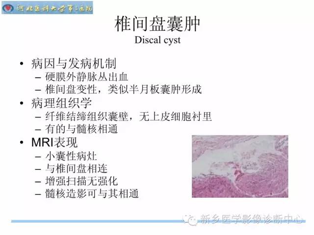 【PPT】椎管内囊性病变影像诊断