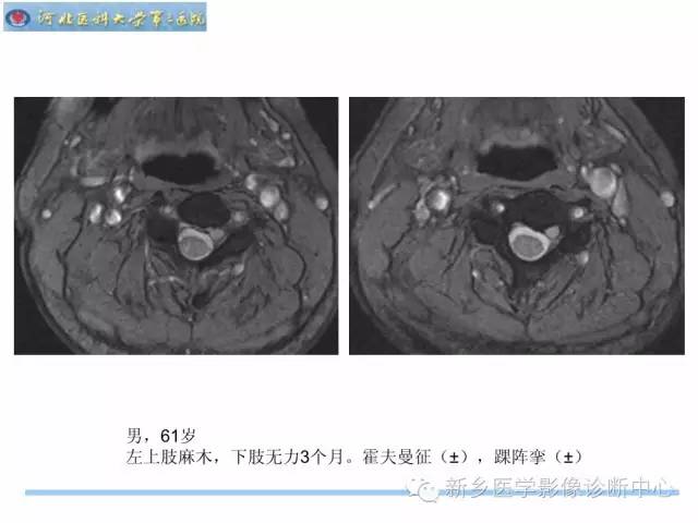 【PPT】椎管内囊性病变影像诊断
