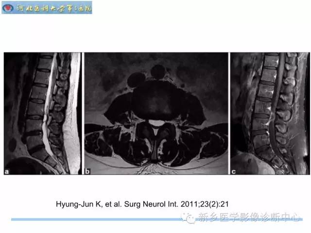 【PPT】椎管内囊性病变影像诊断