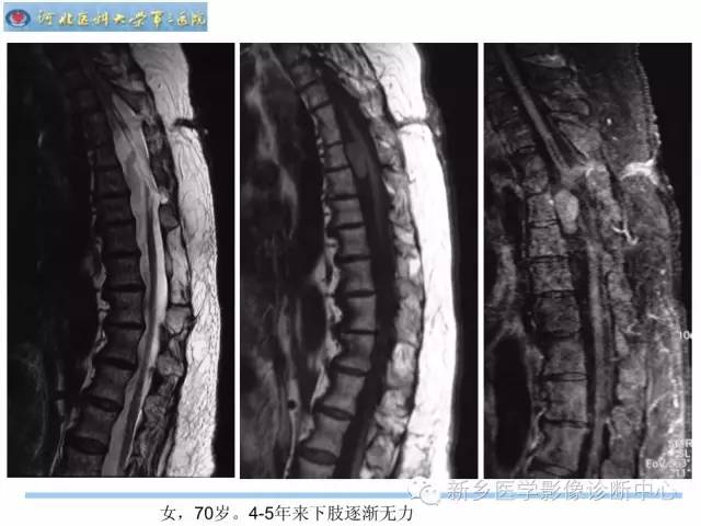 【PPT】椎管内囊性病变影像诊断