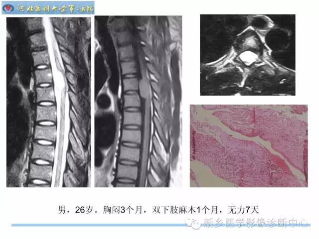 【PPT】椎管内囊性病变影像诊断