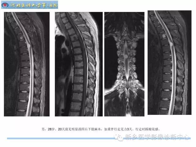 【PPT】椎管内囊性病变影像诊断
