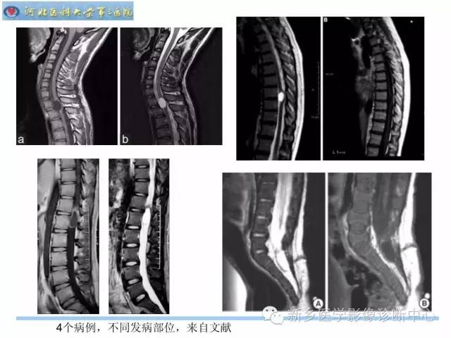 【PPT】椎管内囊性病变影像诊断