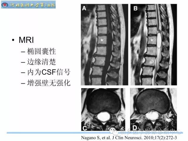 【PPT】椎管内囊性病变影像诊断