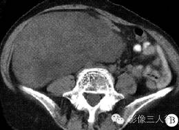 【病例】右侧腹膜后脂肪肉瘤 1例CT影像表现 【病例】右侧腹膜后脂肪肉瘤 1例CT影像表现