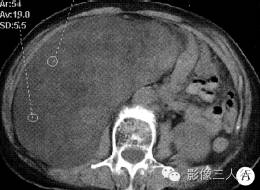 【病例】右侧腹膜后脂肪肉瘤 1例CT影像表现 【病例】右侧腹膜后脂肪肉瘤 1例CT影像表现