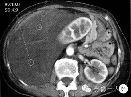 【病例】右侧腹膜后脂肪肉瘤 1例CT影像表现