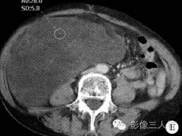 【病例】右侧腹膜后脂肪肉瘤 1例CT影像表现 【病例】右侧腹膜后脂肪肉瘤 1例CT影像表现