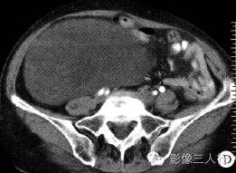 【病例】右侧腹膜后脂肪肉瘤 1例CT影像表现 【病例】右侧腹膜后脂肪肉瘤 1例CT影像表现
