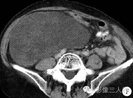 【病例】右侧腹膜后脂肪肉瘤 1例CT影像表现 【病例】右侧腹膜后脂肪肉瘤 1例CT影像表现