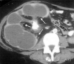 "熊掌征"，这个征象提示啥？