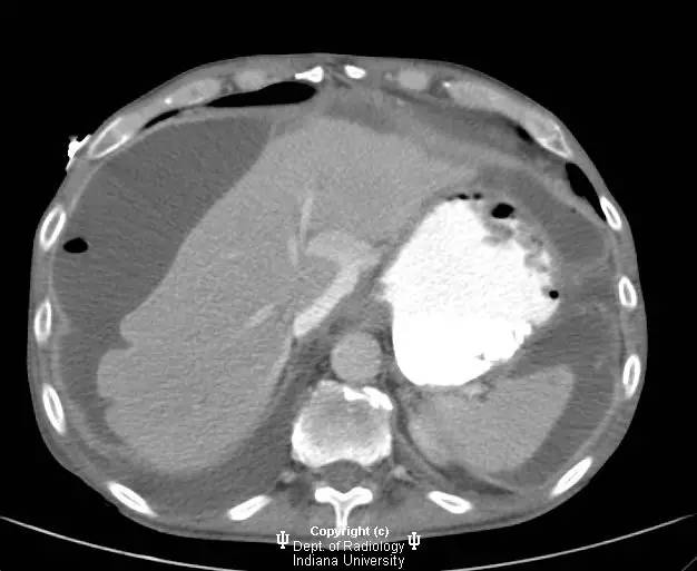【病例】胃溃疡穿孔1例CT