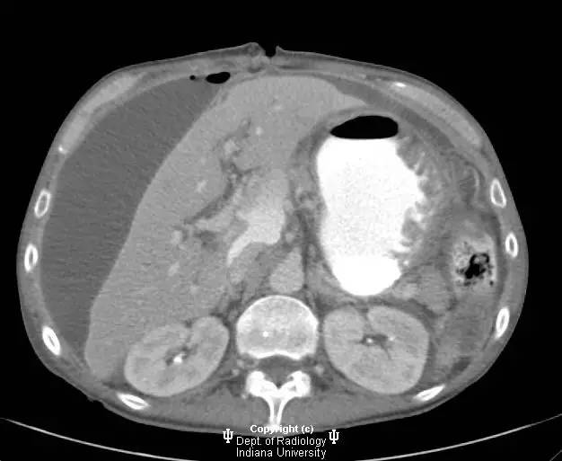 【病例】胃溃疡穿孔1例CT