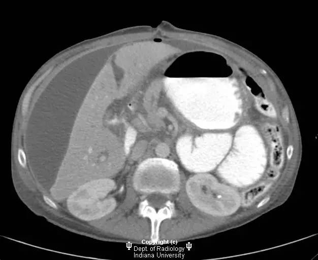 【病例】胃溃疡穿孔1例CT